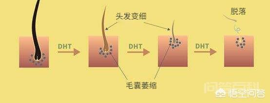 后枕部头发、毛囊为何坚固无比很难脱落? 谢邀。我是王勇医生。我来回答这个问题。