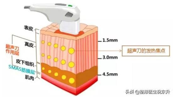 超声刀美容失败怎么办? 同题参见不过正规医生操作的超声刀知道