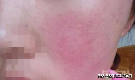 超声刀美容失败怎么办? 造成皮下热损伤