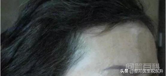 超声刀美容失败怎么办? 组织受热损伤增生后皮肤自然变细腻紧致