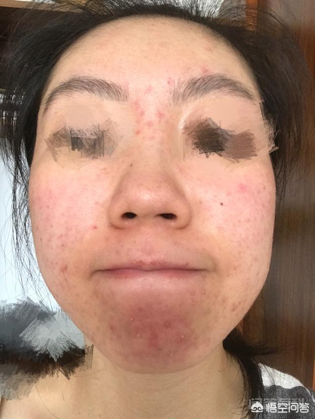 脸上长满痘痘怎么办? 在2017年因为使用了面膜导致过敏
