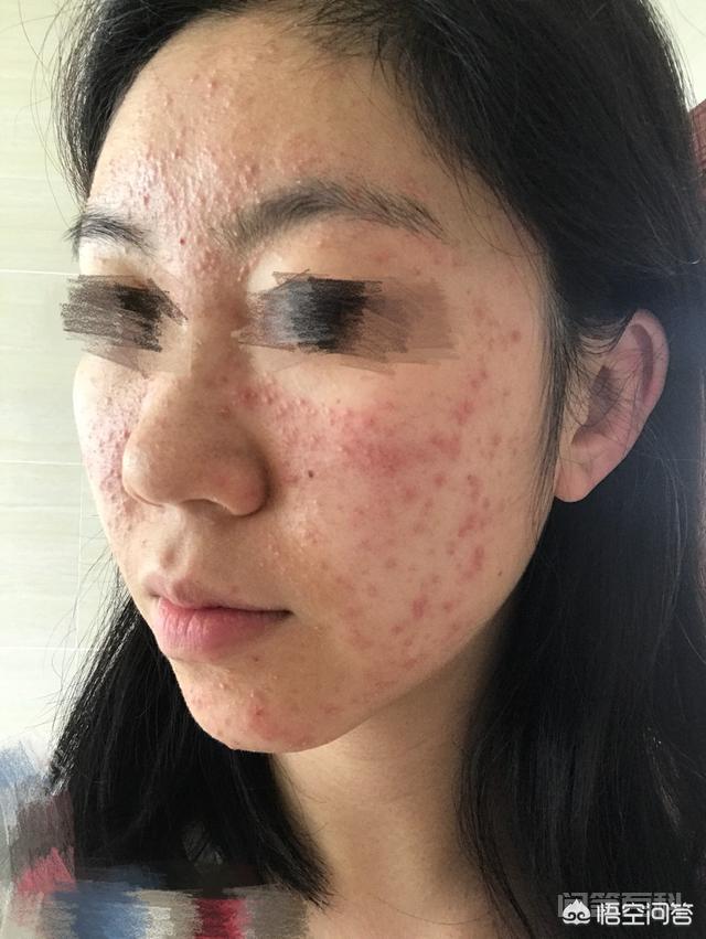 脸上长满痘痘怎么办? 我现在的脸部基本已经恢复了