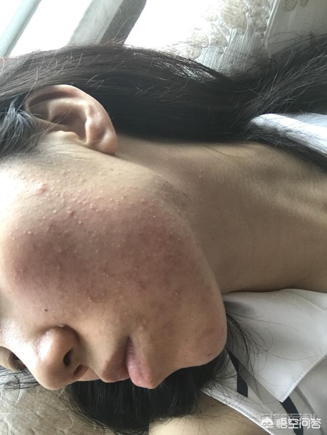 脸上长满痘痘怎么办? 期间又走了弯路由一开始的过敏痘痘转变