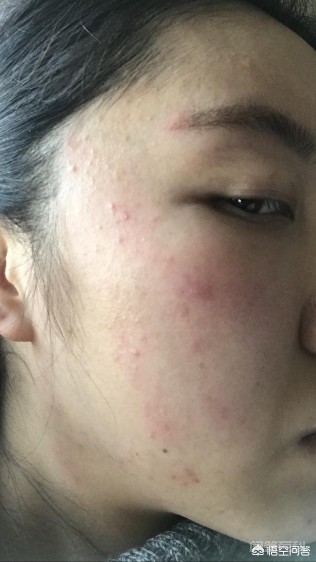 脸上长满痘痘怎么办? 经历了将近10个月左右的时间脸部才恢