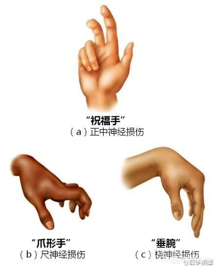 左手的手背不能抬起,手指伸不直是开云手机站登录入口正规渠道情况? 欢迎关注麻醉医生谈健康