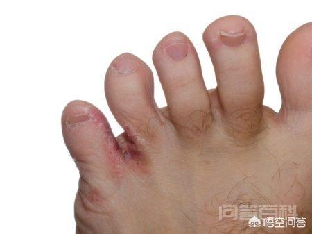 我家小孩六岁就有脚气该怎么办?有开云手机版登录偏方可以治疗吗? 脚气是常见病