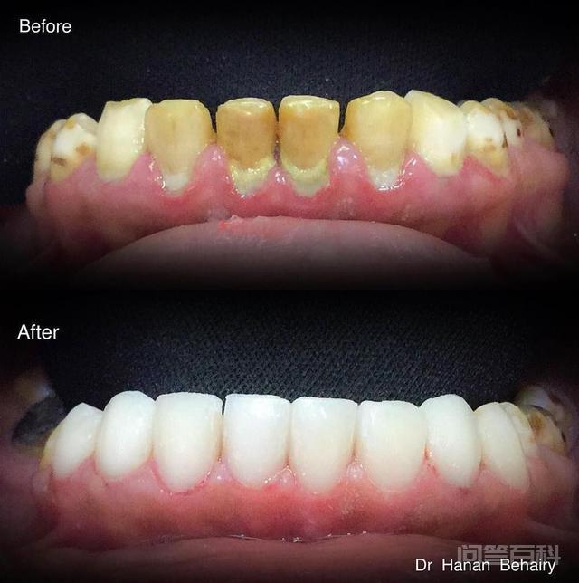 刷牙怎么刷才能刷白牙齿? 作为牙医