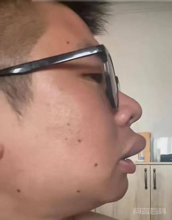 被蚊子咬嘴唇后,网友竟排队笑 随时可能