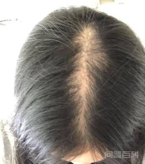 传说中的侧柏叶洗头正能生发吗