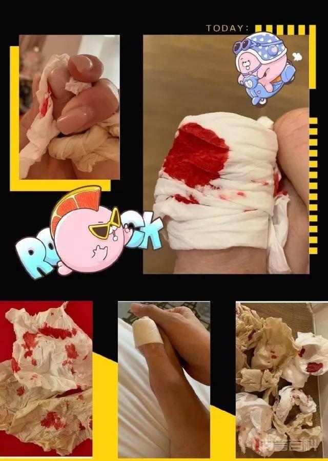 人气女星不慎发生意外踢爆脚趾:希望伤口不要再爆开 艺人李彩华就在社交网上上载了照片
