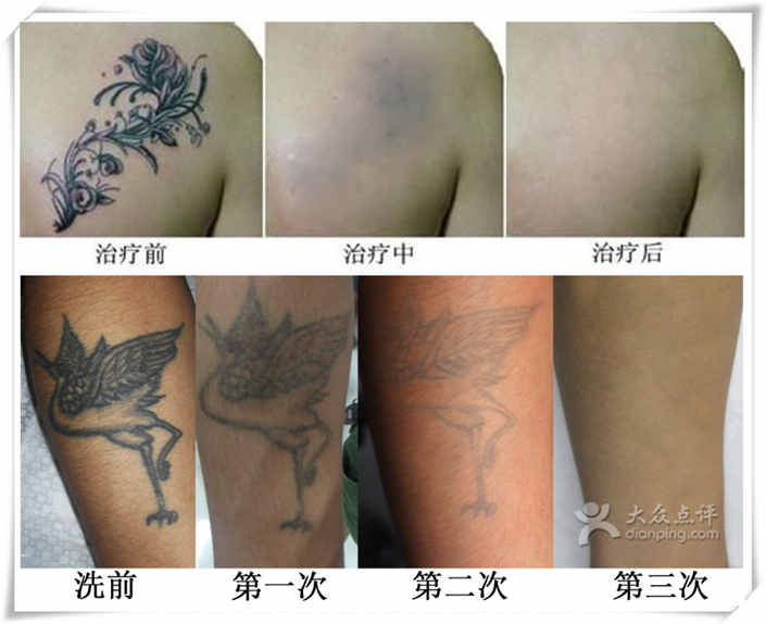 三种帮你彻底清除纹身的方法(图) 一、洗一次纹身间隔多久
