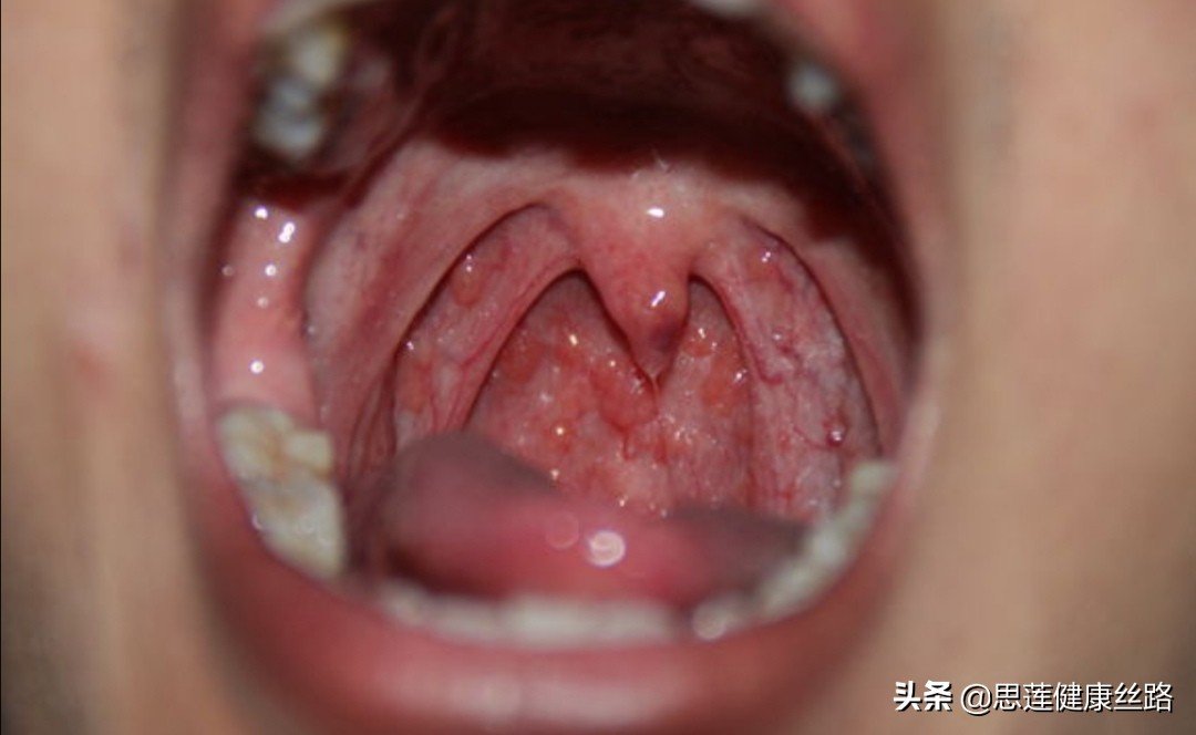 开始有过敏性鼻炎的症状